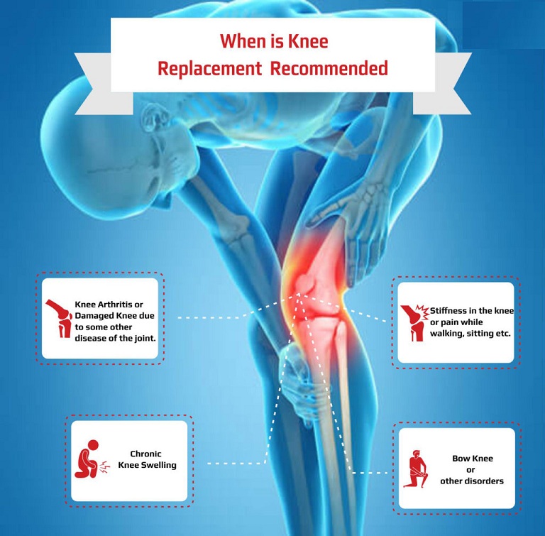 Knee Replacement